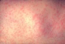 A photo of a patient with measels.
