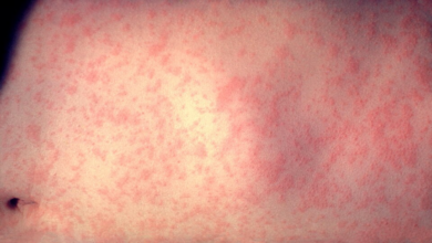 A photo of a patient with measels.
