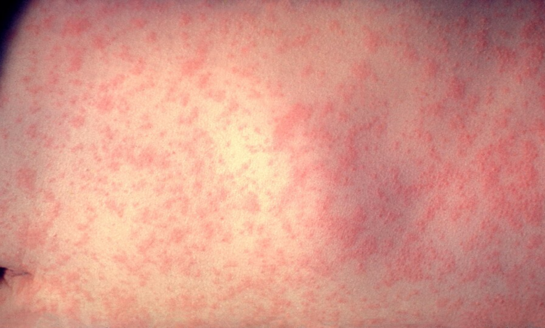 A photo of a patient with measels.